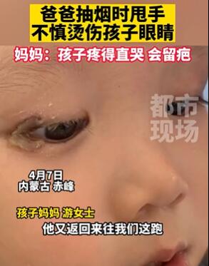 爸爸抽烟时甩手烫伤孩子眼睛